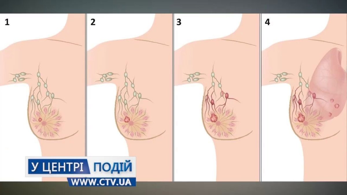 Карцинома грудной железы